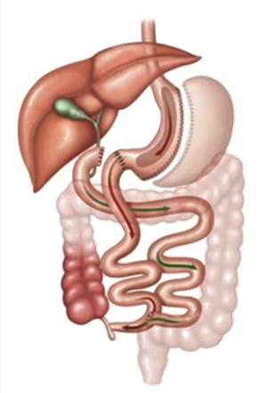 terapia-5-duodenal-switch-scopinaro